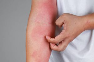 Может ли у вас быть аллергия на каннабис?